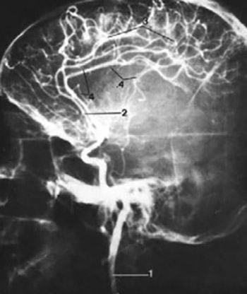 Significance of establishing collateral circulation by leptomeningeal anastomoses in the occlusion of arteriae cerebri mediae