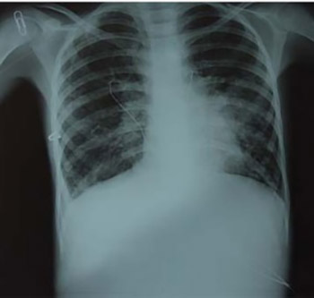 Therapeutic flexible bronchoscopy in child with cystic fibrosis