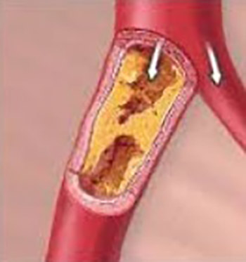 Pathohistological changes in diffuse coronary atherosclerosis and chronic infection caused by Chlamydia pneumonia