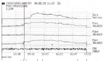 Detrusor contraction duration and strength in the patients with benign prostatic enlargement