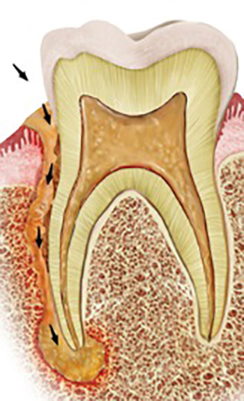 Endodontic-periodontal locally delivered antibiotics