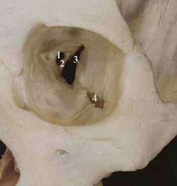 Computed tomography review of the osseous structures of the orbital apex