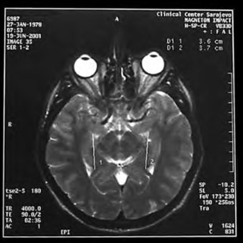 Asymmetry of limbic structure (hippocampal formation and amygdaloidal complex) at PTSD