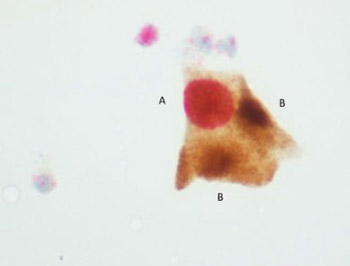 human papillomavirus p16 staining)