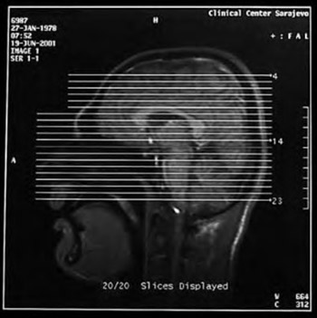 Observing of the asymmetry of hippocampal formation on patients with complex partial attacks