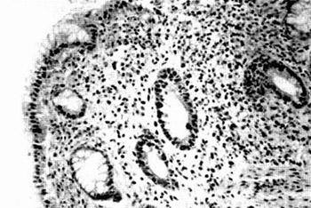 Local Cellular Immune Response in Dysplastic Epithelial Lesions of the Flat Colonic Mucosa