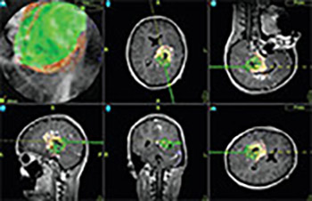 Review of first clinical experiences with a 1.5 Tesla ceiling-mounted moveable intraoperative MRI system in Europe