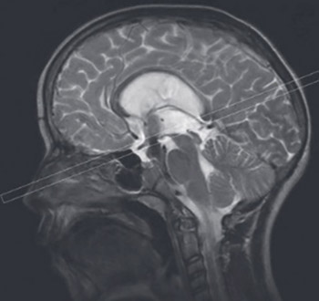 Dynamic Magnetic Resonance Imaging of Endoscopic Third Ventriculostomy Patency With Differently Acquired Fast Imaging With Steady-State Precission Sequences