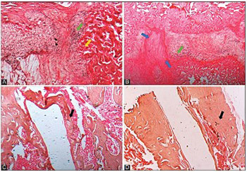 Enhancement of bone consolidation using high-frequency pulsed electromagnetic fields (HF-PEMFs): An experimental study on rats