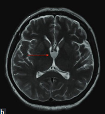 Colloid cysts of the third ventricle exhibit various clinical presentation: a review of three cases