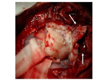 Soft tissue grafts for dural reconstruction after meningioma surgery