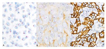 Internodal HER2 heterogeneity of axillary lymph node metastases in breast cancer patients