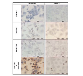 Valspodar-modulated chemotherapy in human ovarian cancer cells SK-OV-3 and MDAH-2774