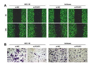 PCAT1 is a poor prognostic factor in endometrial carcinoma and associated with cancer cell proliferation, migration and invasion