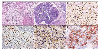 Clear cell urothelial carcinoma of the urinary bladder - a rare pathological entity. A case report and a systematic review of the literature