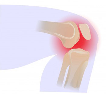 The use of cellular matrix in symptomatic knee osteoarthritis