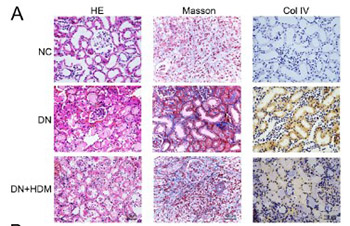 Dihydromyricetin promotes autophagy and attenuates renal interstitial fibrosis by regulating miR-155-5p/PTEN signaling in diabetic nephropathy