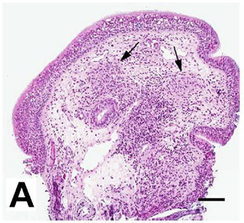 Laryngeal tuberculosis in renal transplant recipients: A case report and review of the literature