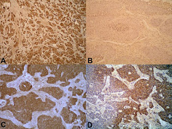 Inflammation-related cytokines and their roles in gastroenteropancreatic neuroendocrine neoplasms