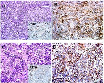 Concordance of PD-L1 expression and CD8+ TIL intensity between NSCLC and synchronous brain metastases