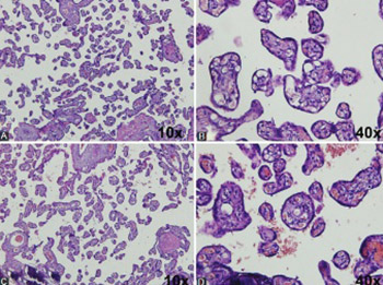 Stereological analysis of terminal villi of the placentas of pregnant woman with sideropenic anemia