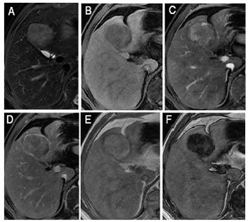 Diagnostic performance of LI-RADS version 2018 in differentiating hepatocellular carcinoma from other hepatic malignancies in patients with hepatitis B virus infection