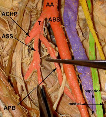 Upper limb principal arteries variations: A cadaveric study with terminological implication