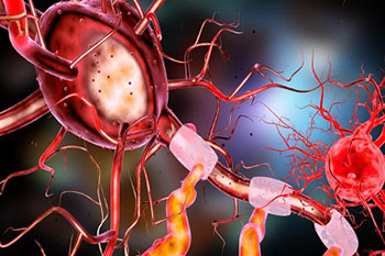 Post-operative functional neurological symptom disorder after anesthesia