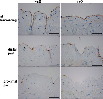 Endothelial loss during the surgical procedure in saphenous veins harvested by open and endoscopic techniques in coronary artery bypass surgery