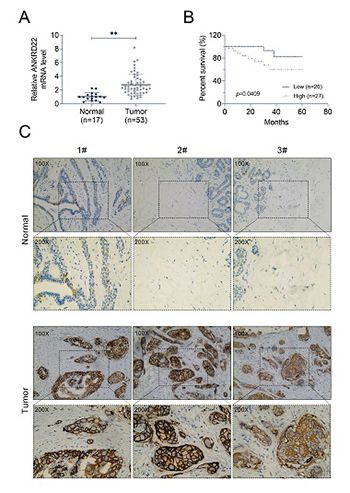 ANKRD22 enhances breast cancer cell malignancy by activating the Wnt/β-catenin pathway via modulating NuSAP1 expression