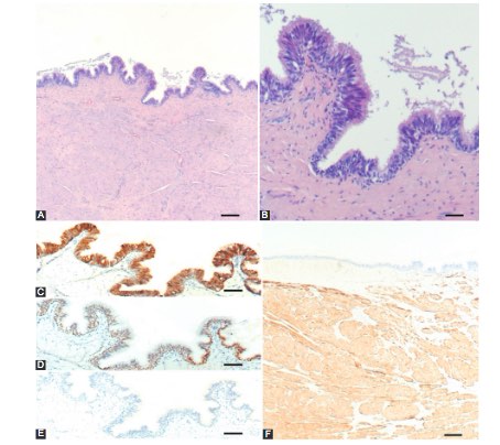 Lingual cyst with respiratory epithelium: The importance of differential diagnosis