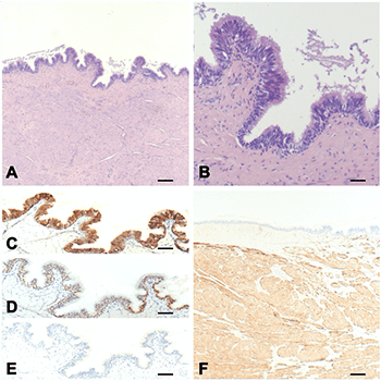 Lingual cyst with respiratory epithelium: The importance of differential diagnosis