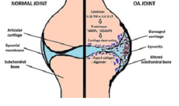 An insight into osteoarthritis susceptibility: Integration of immunological and genetic background