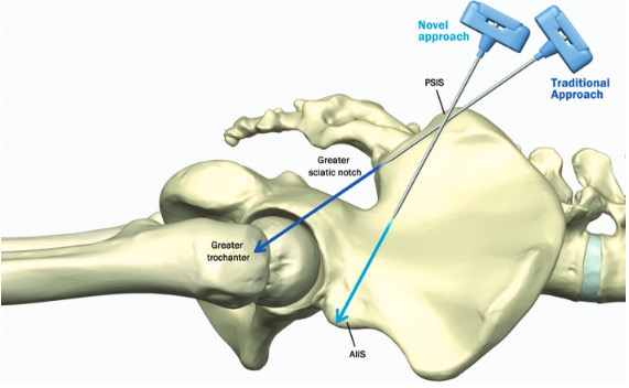 A three-dimensional computed tomography study to determine the ideal method for fluoroscopically-guided bone marrow aspiration from the iliac crest