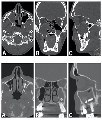 Chronic maxillary sinusitis of dental origin and oroantral fistula: The results of combined surgical approach in an Italian university hospital