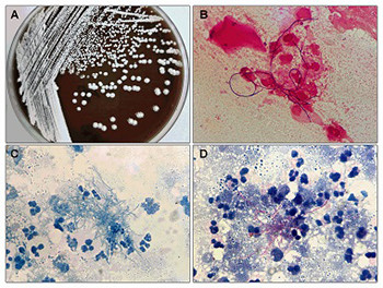 Clinical Nocardia species: Identification, clinical characteristics, and antimicrobial susceptibility in Shandong, China