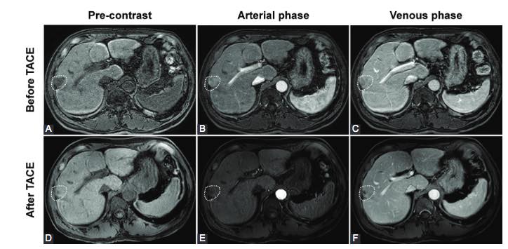 Safety and effectiveness of new embolization microspheres SCBRM for intermediate-stage hepatocellular carcinoma: A feasibility study