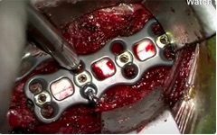 Surgical anatomy of microsurgical 3-level anterior cervical discectomy and fusion C4–C7