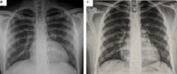 Kawasaki-like disease and acute myocarditis in the SARS-CoV-2 pandemic – reports of three adolescents