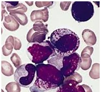 Cryptic t(15;17) acute promyelocytic leukemia with a karyotype of add(11)(p15) and t(13,20)- A case report with a literature review