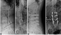 Extreme lateral interbody fusion (XLIF) in a consecutive series of 72 patients