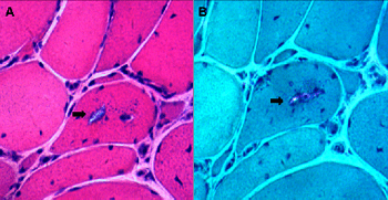 A novel homozygous exon2 deletion of TRIM32 gene in a Chinese patient with sarcotubular myopathy: A case report and literature review