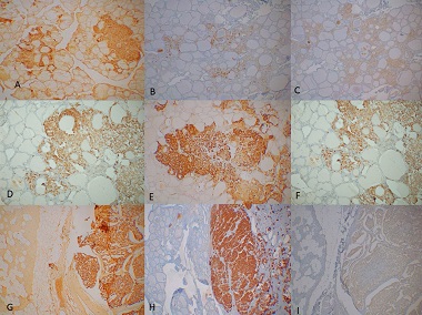 Significance of chromogranin A and synaptophysin in medullary thyroid carcinomas
