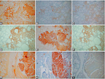 Significance of chromogranin A and synaptophysin in medullary thyroid carcinomas