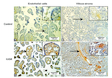 Dishevelled family proteins (DVL1-3) expression in intrauterine growth restriction (IUGR) placentas