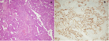 The impact of Ki-67 index, squamous differentiation and several clinicopathologic parameters on the recurrence of low and intermediate-risk endometrial cancer