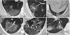 Predictive performance of CT for adverse outcomes among COVID-19 suspected patients: a two-center retrospective study