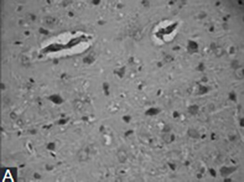 Impacts of N-Butylphthalide on expression of growth factors in rats with focal cerebral ischemia