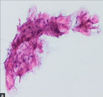 Diagnostic dilemma of parotid lipomas: imaging versus fine needle aspiration cytology