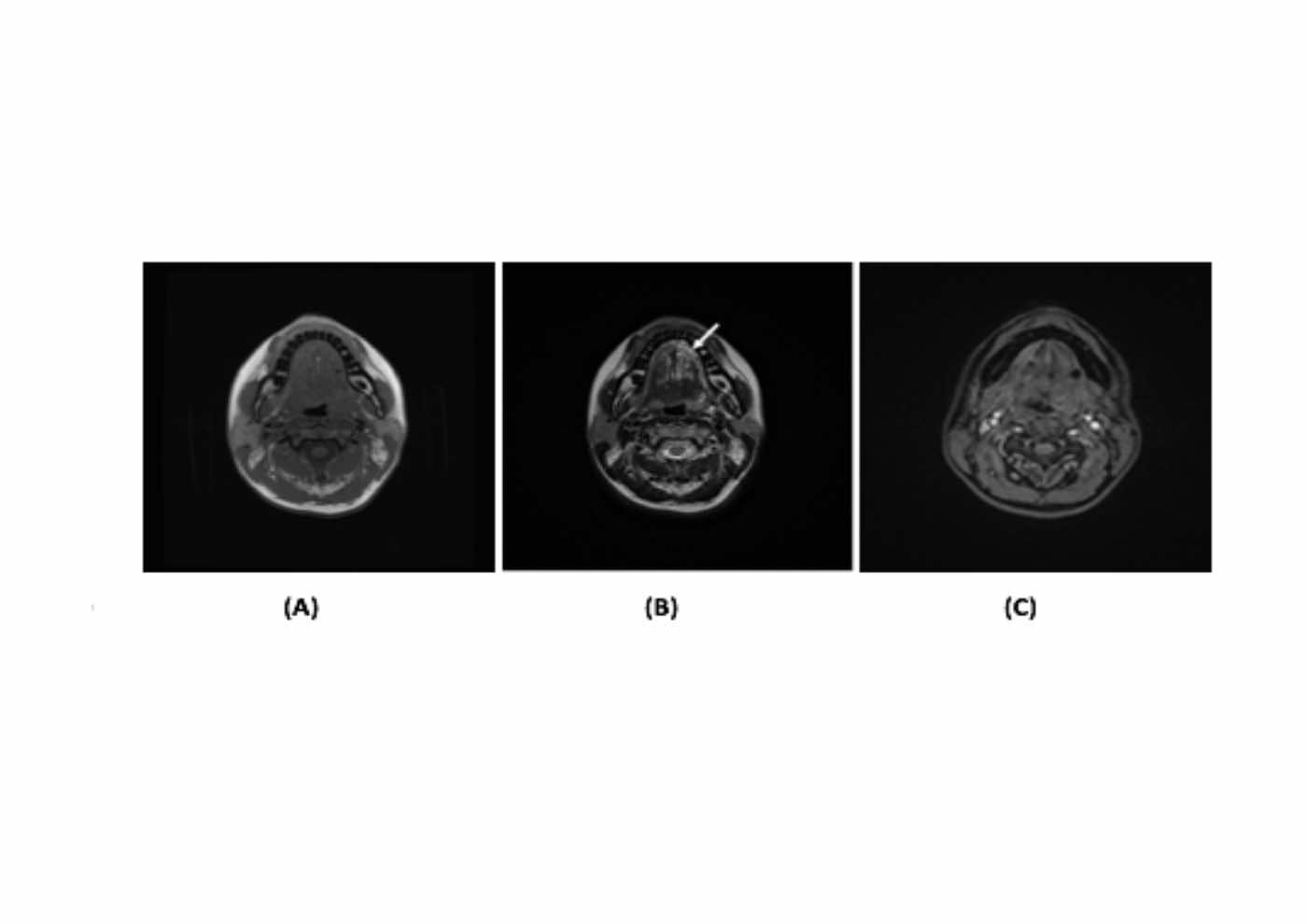 Role of dynamic contrast enhanced magnetic resonance imaging in the diagnosis and management of vascular lesions of the head and neck